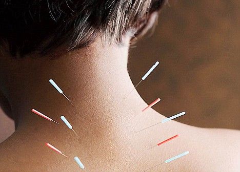 Dry Needling & Acupuncture